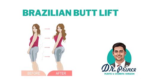 brazilian butt lift philippines|Best BBL, Brazilian Butt Lifting surgeon .